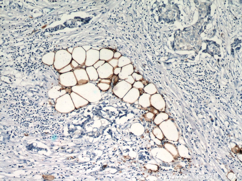 Immunohistochemistry (IHC) staining of human breast cancer tissue using FABP4 Polyclonal antibody (12802-1-AP)