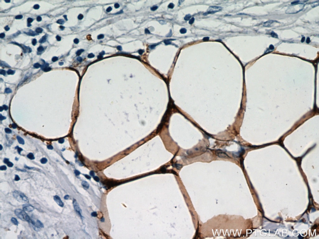 Immunohistochemistry (IHC) staining of human breast cancer tissue using FABP4 Polyclonal antibody (12802-1-AP)