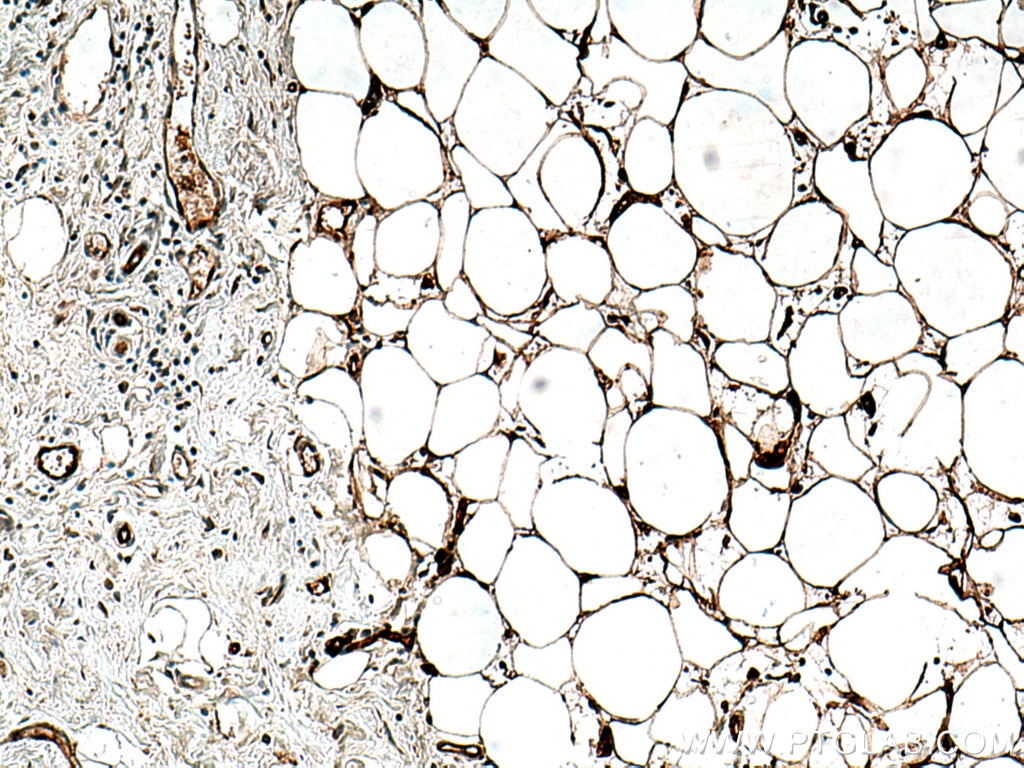 Immunohistochemistry (IHC) staining of human breast cancer tissue using FABP4 Monoclonal antibody (67167-1-Ig)
