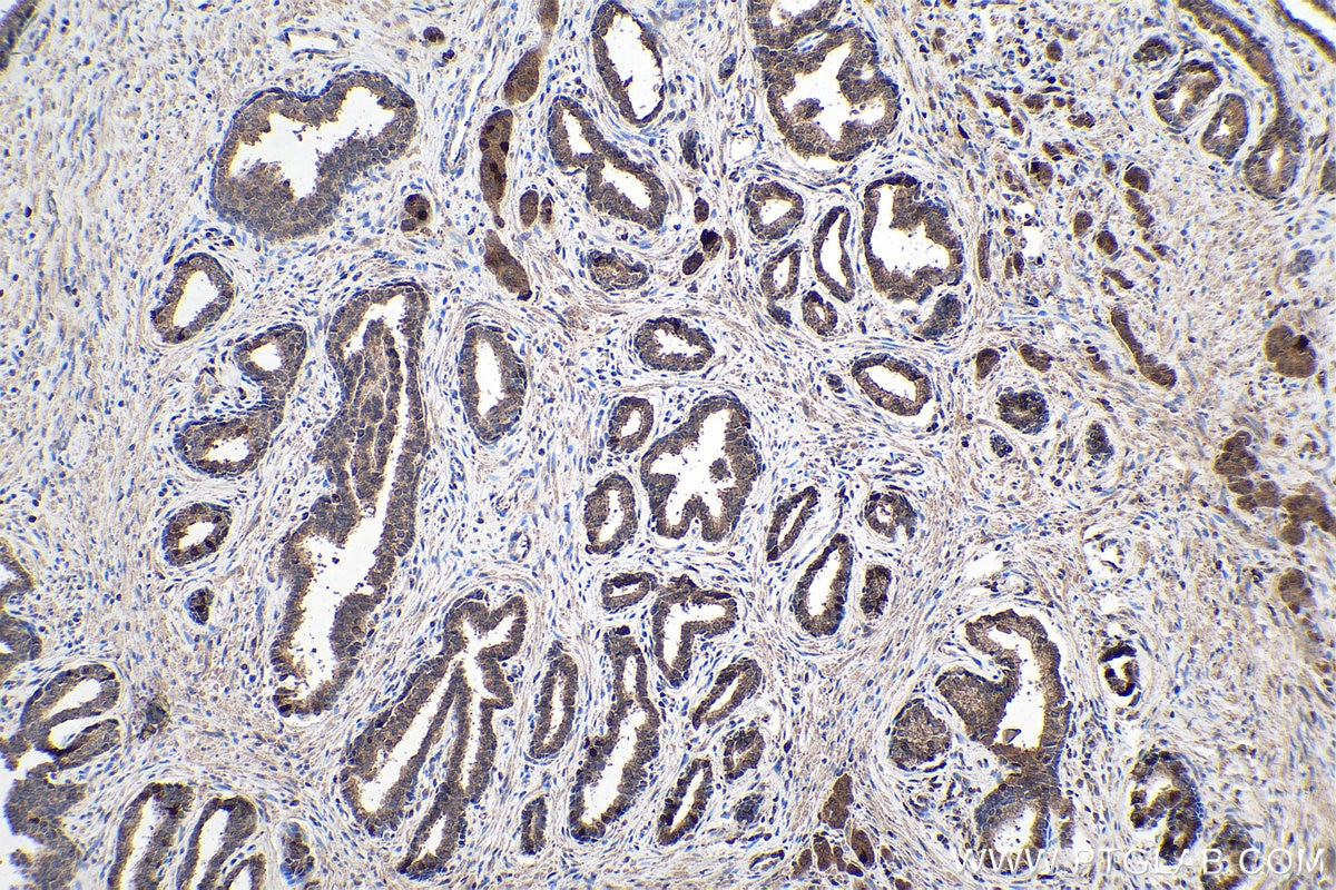 Immunohistochemistry (IHC) staining of human prostate cancer tissue using FABP5 Monoclonal antibody (66299-1-Ig)