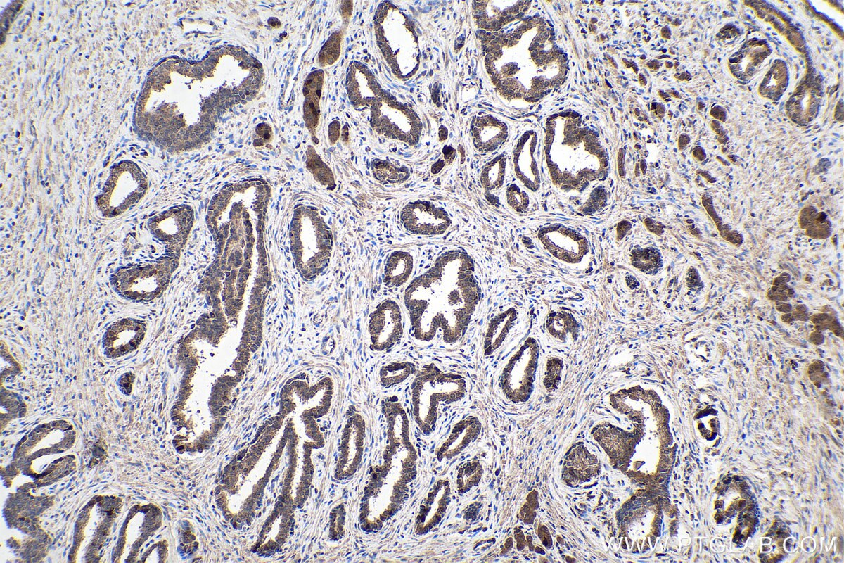 IHC staining of human prostate cancer using 66299-1-Ig