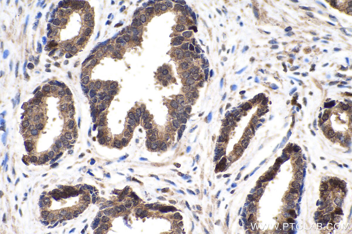 Immunohistochemistry (IHC) staining of human prostate cancer tissue using FABP5 Monoclonal antibody (66299-1-Ig)