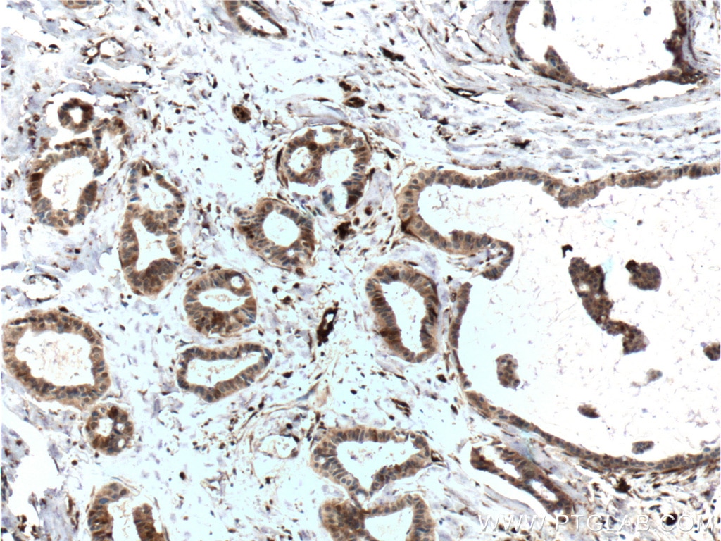 Immunohistochemistry (IHC) staining of human breast cancer tissue using FABP5 Monoclonal antibody (66299-1-Ig)