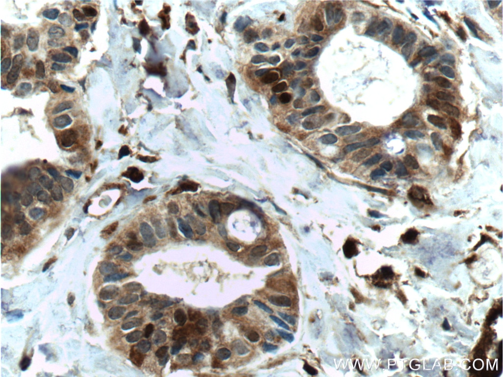 Immunohistochemistry (IHC) staining of human breast cancer tissue using FABP5 Monoclonal antibody (66299-1-Ig)