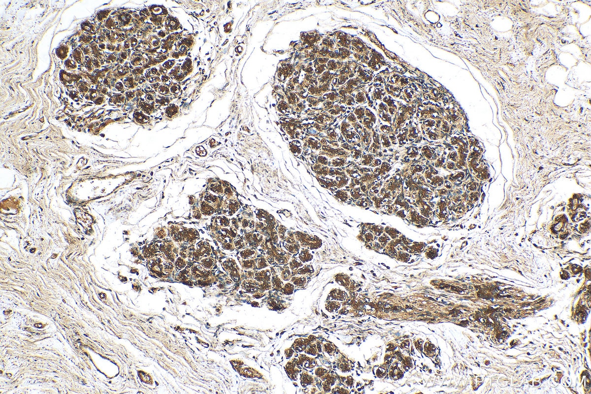 Immunohistochemistry (IHC) staining of human breast cancer tissue using FABP7 Polyclonal antibody (51010-1-AP)