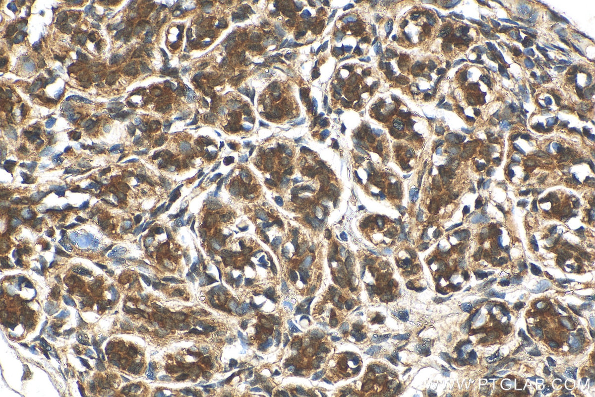 Immunohistochemistry (IHC) staining of human breast cancer tissue using FABP7 Polyclonal antibody (51010-1-AP)