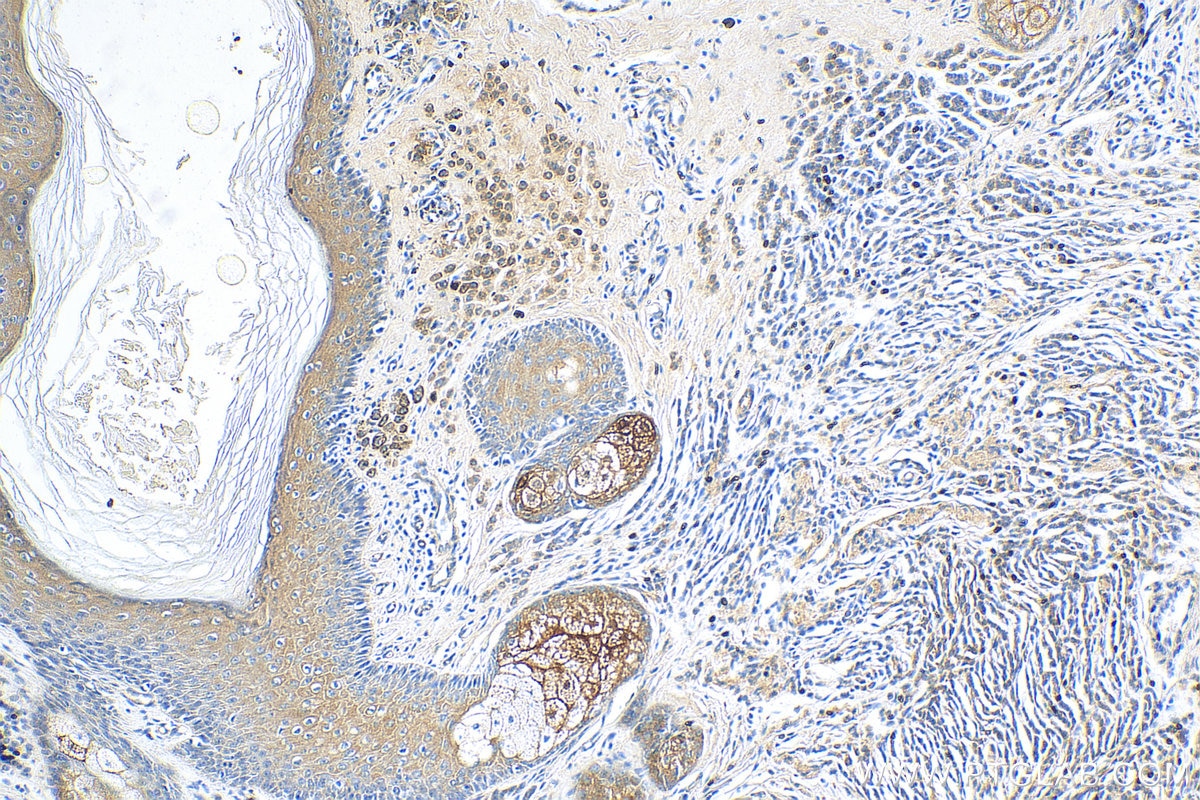 Immunohistochemistry (IHC) staining of human malignant melanoma tissue using FABP7 Polyclonal antibody (51010-1-AP)
