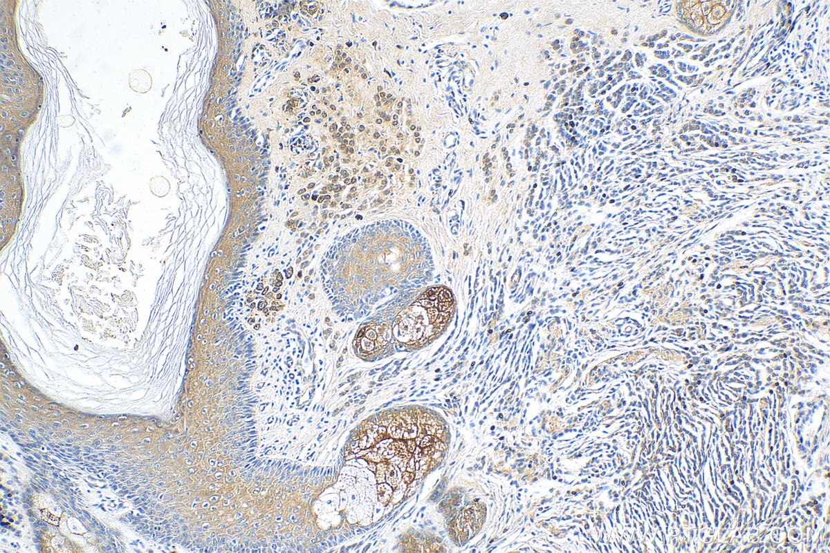 IHC staining of human malignant melanoma using 51010-1-AP