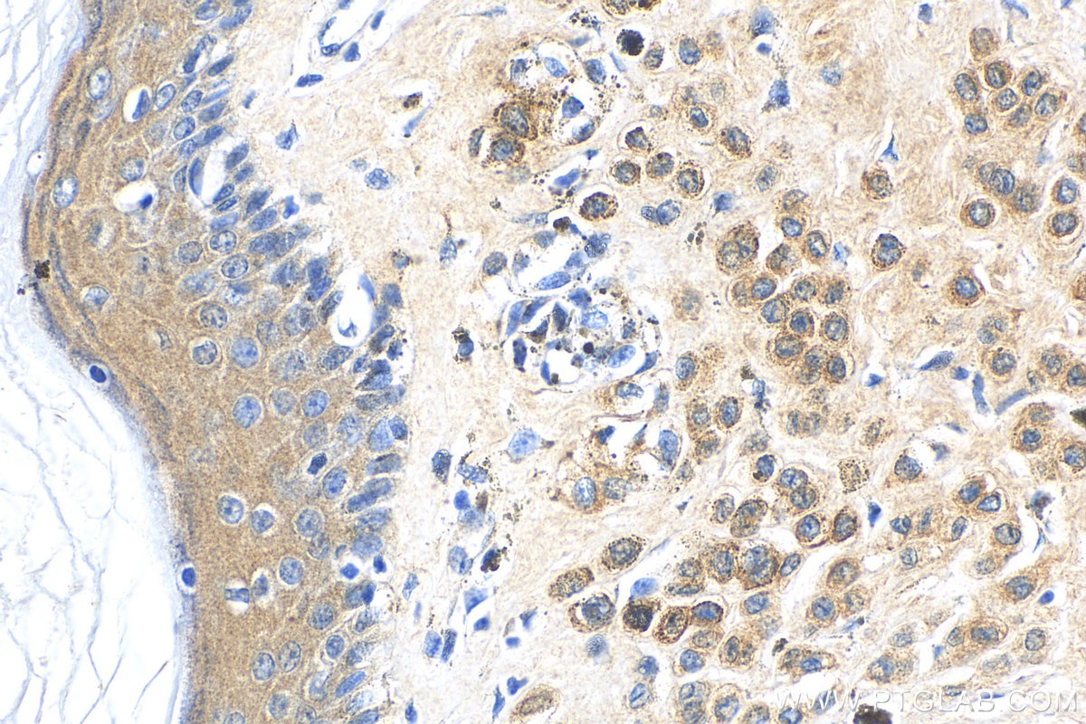 Immunohistochemistry (IHC) staining of human malignant melanoma tissue using FABP7 Polyclonal antibody (51010-1-AP)