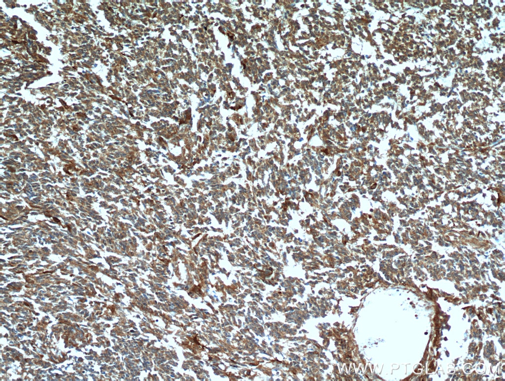 IHC staining of human gliomas using 51010-1-AP