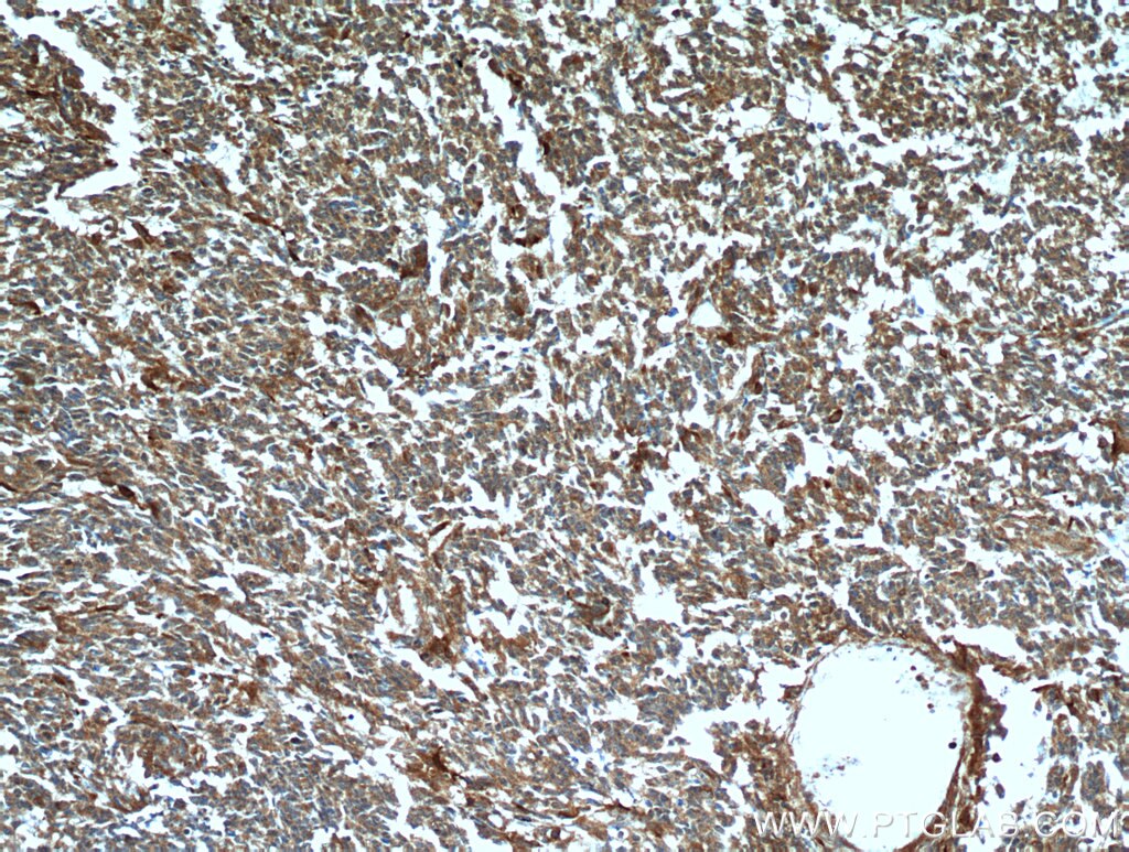 Immunohistochemistry (IHC) staining of human gliomas tissue using FABP7 Polyclonal antibody (51010-1-AP)