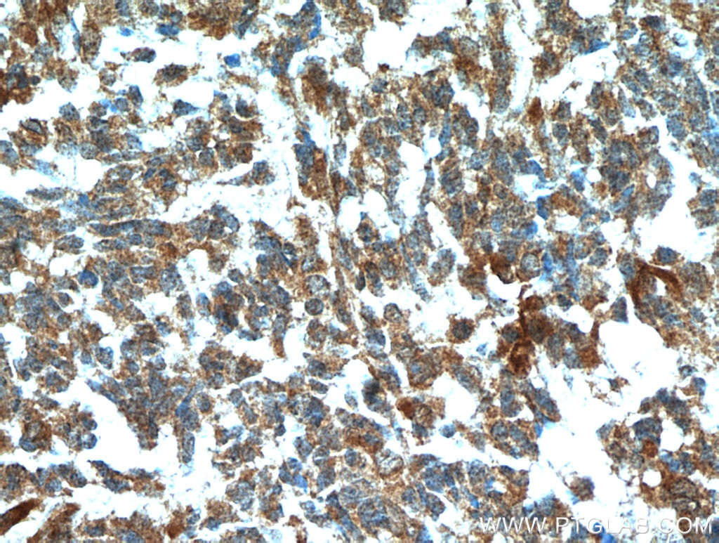 Immunohistochemistry (IHC) staining of human gliomas tissue using FABP7 Polyclonal antibody (51010-1-AP)