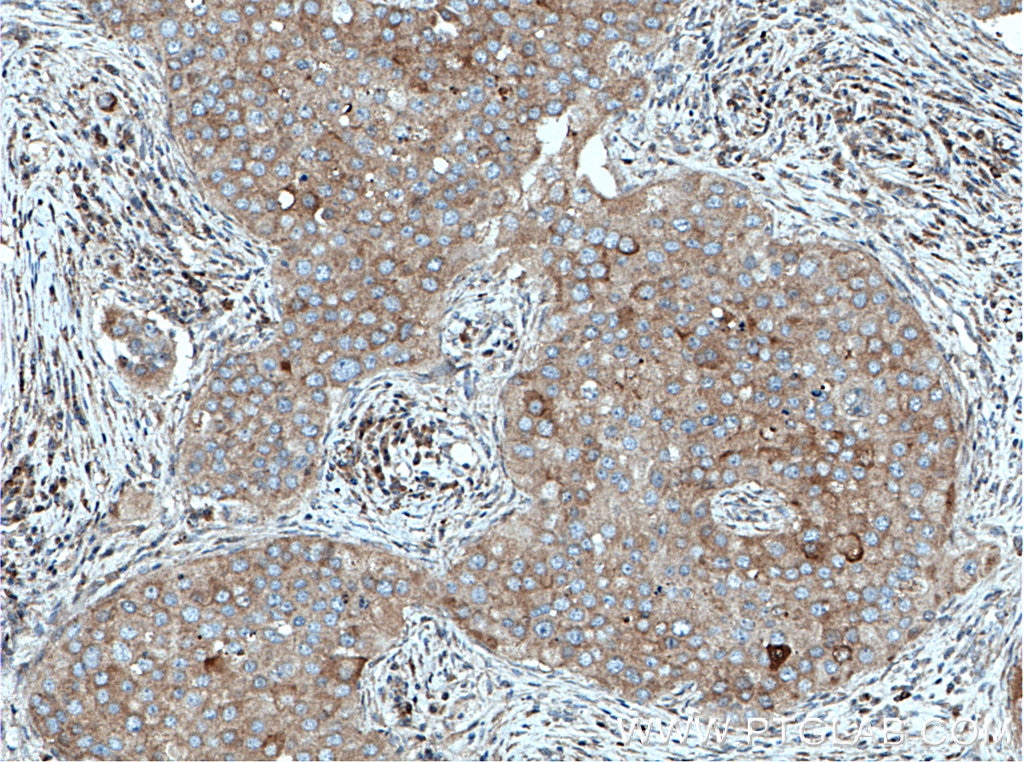 Immunohistochemistry (IHC) staining of human breast cancer tissue using FABP7-Specific Polyclonal antibody (14836-1-AP)