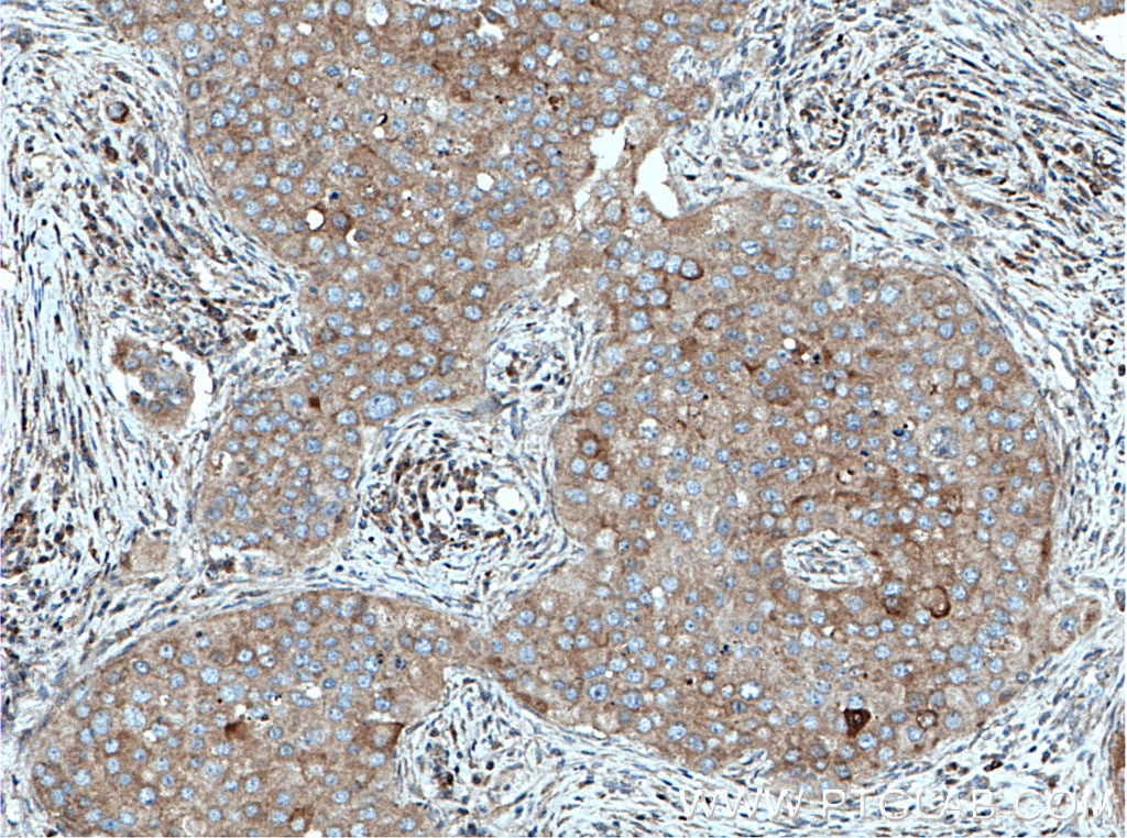 IHC staining of human breast cancer using 14836-1-AP