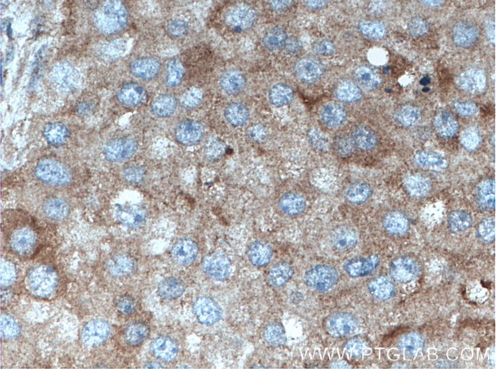 Immunohistochemistry (IHC) staining of human breast cancer tissue using FABP7-Specific Polyclonal antibody (14836-1-AP)