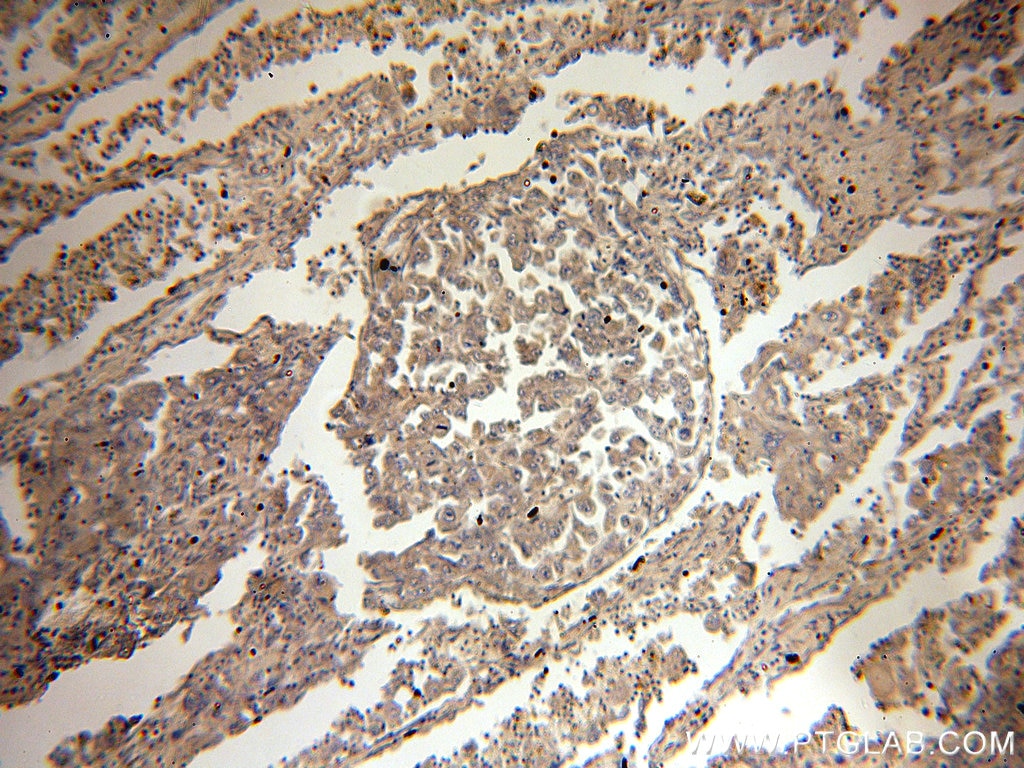 IHC staining of human lung cancer using 14906-1-AP