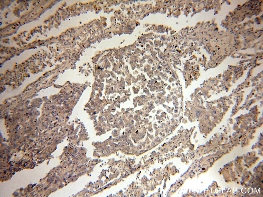 Immunohistochemistry (IHC) staining of human lung cancer tissue using FADD Polyclonal antibody (14906-1-AP)