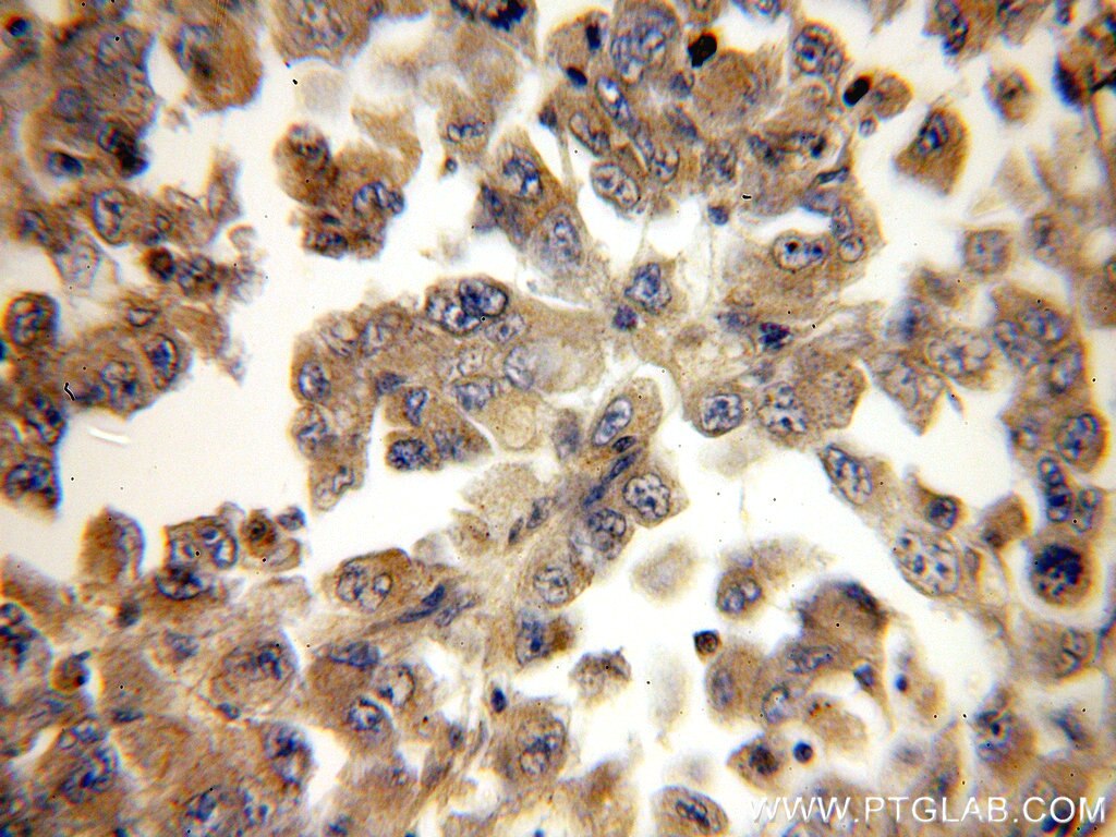 IHC staining of human lung cancer using 14906-1-AP