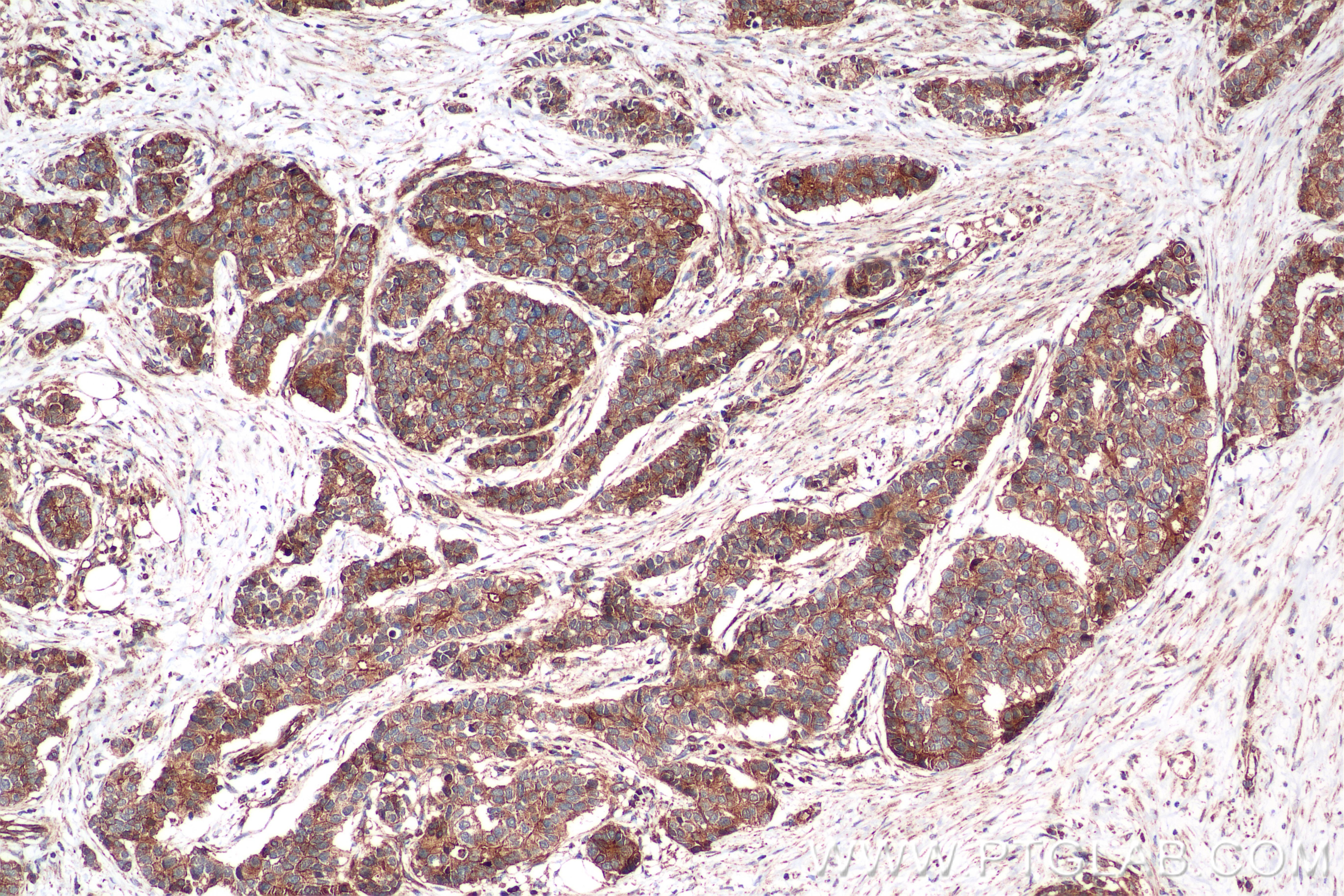 Immunohistochemistry (IHC) staining of human stomach cancer tissue using FADD Recombinant antibody (84619-5-RR)