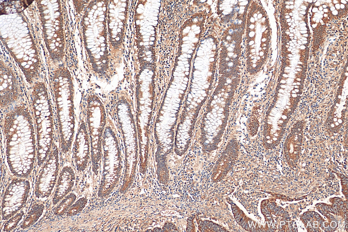 Immunohistochemistry (IHC) staining of human colon cancer tissue using FADS1 Polyclonal antibody (10627-1-AP)