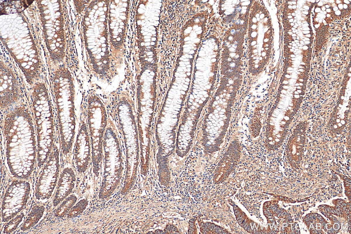 IHC staining of human colon cancer using 10627-1-AP