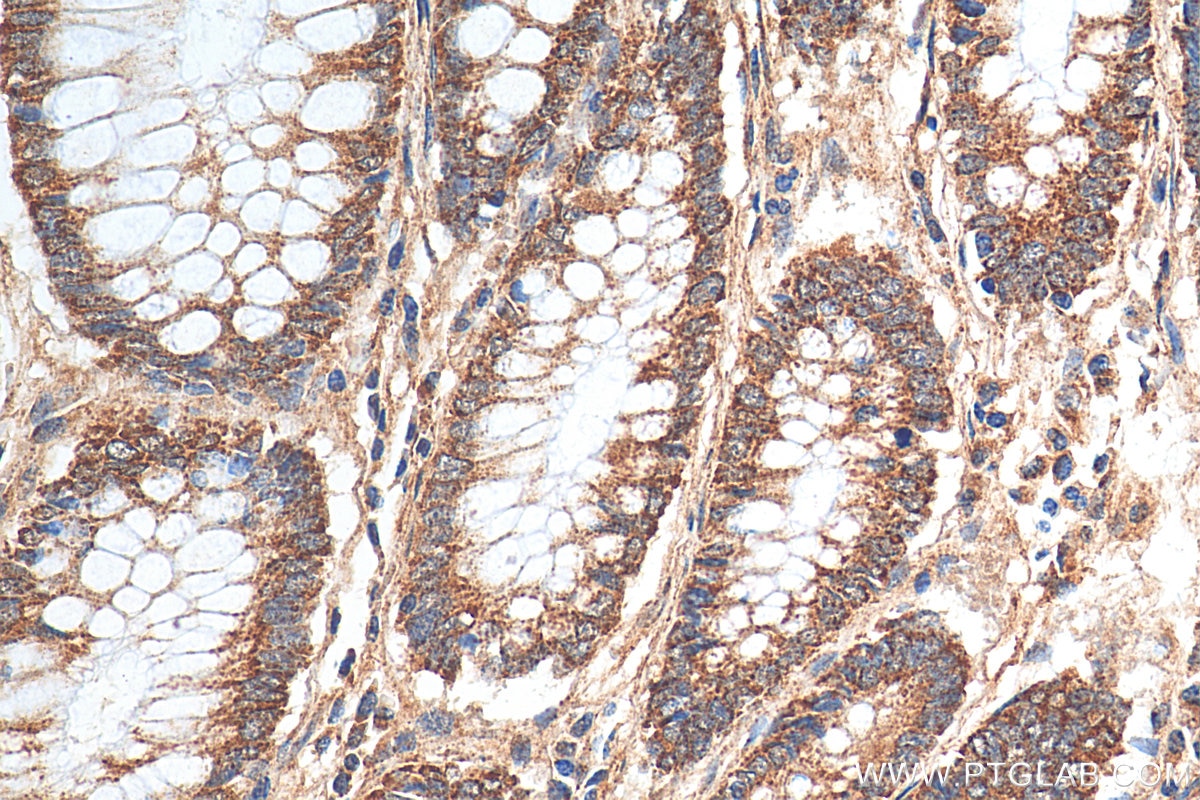 Immunohistochemistry (IHC) staining of human colon cancer tissue using FADS1 Polyclonal antibody (10627-1-AP)