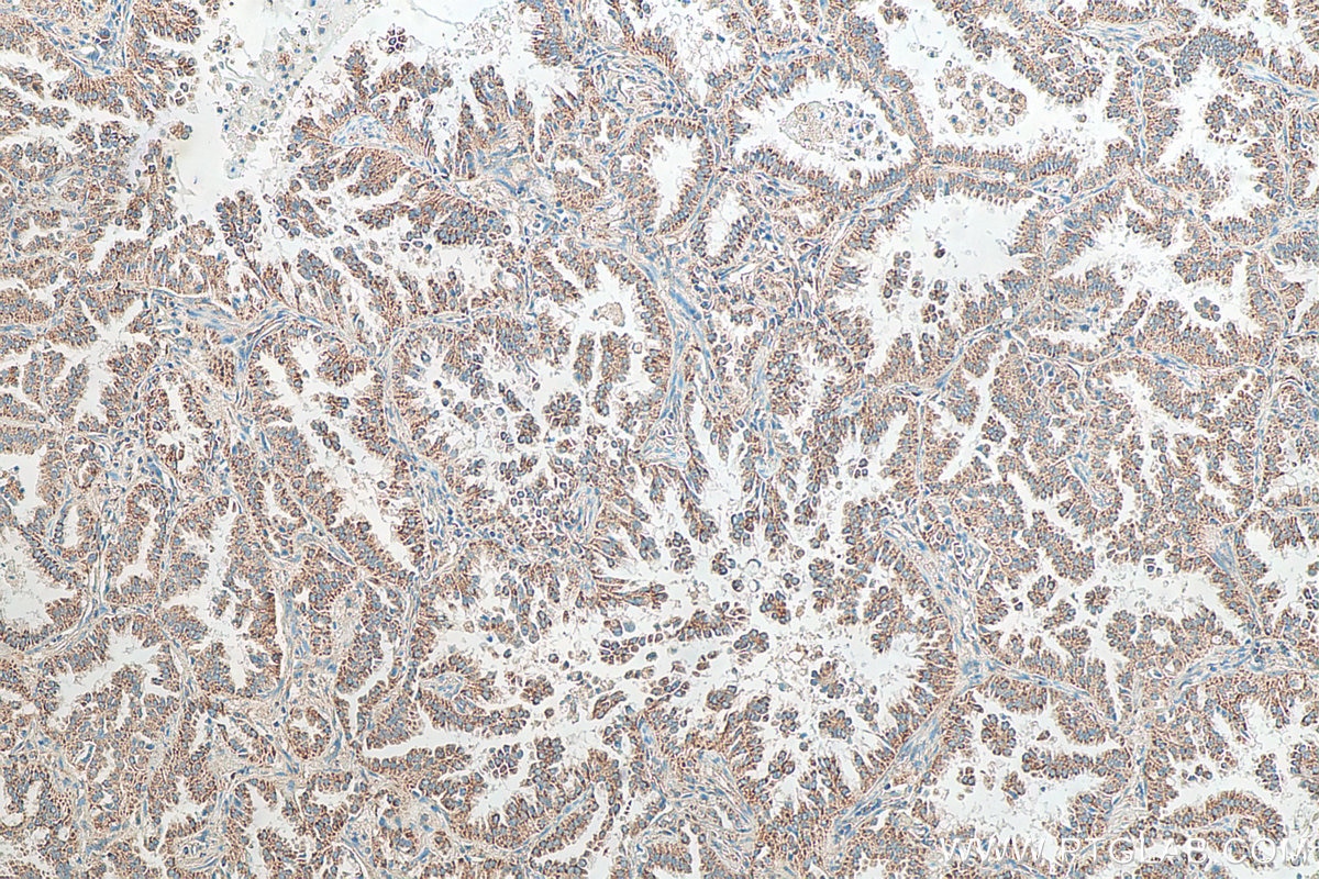 Immunohistochemistry (IHC) staining of human lung cancer tissue using FADS1 Polyclonal antibody (10627-1-AP)