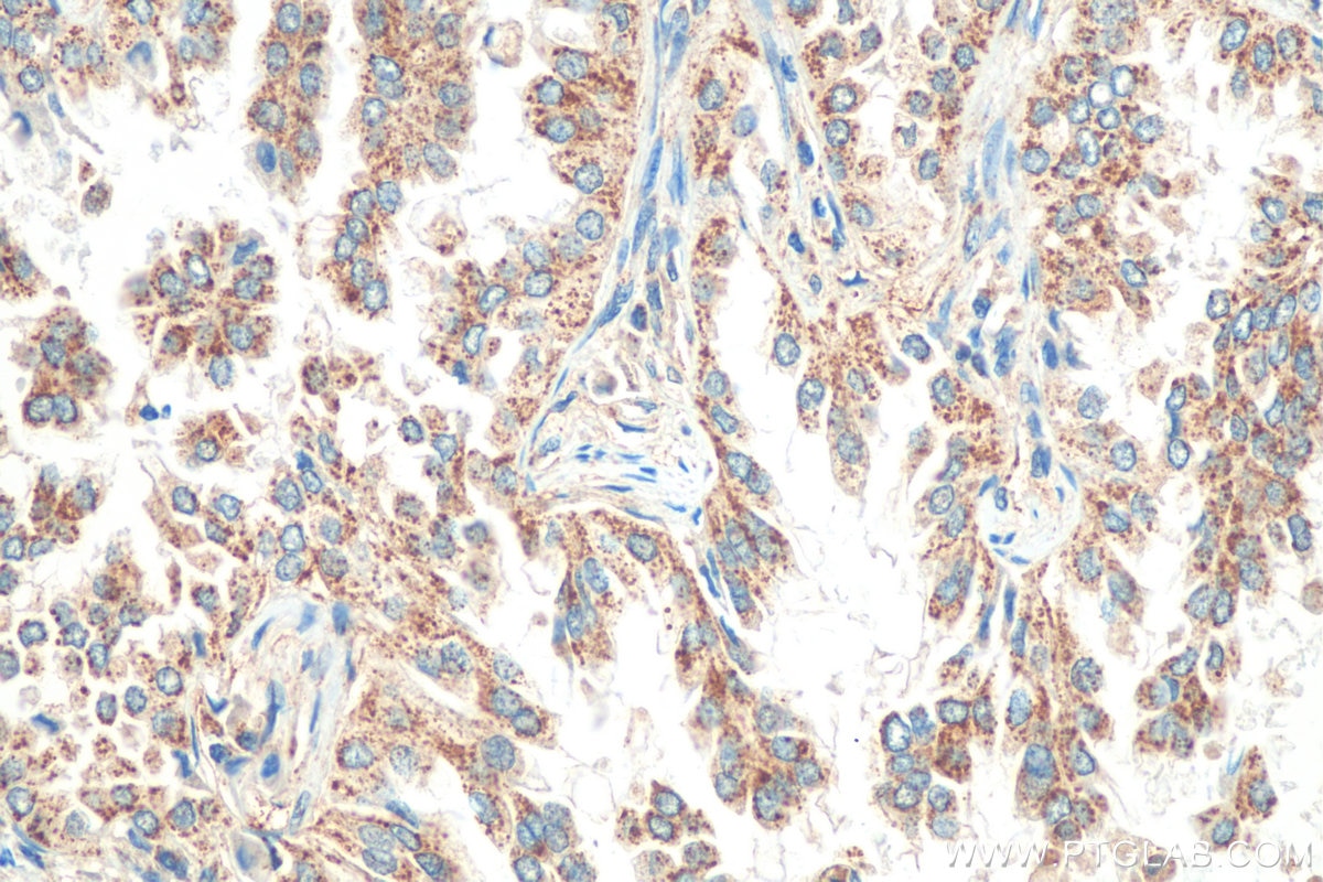 Immunohistochemistry (IHC) staining of human lung cancer tissue using FADS1 Polyclonal antibody (10627-1-AP)