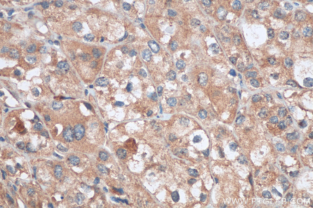 Immunohistochemistry (IHC) staining of human endometrial cancer tissue using FADS1 Polyclonal antibody (10627-1-AP)