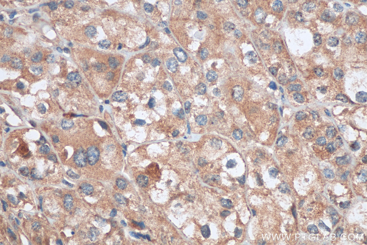 IHC staining of human endometrial cancer using 10627-1-AP