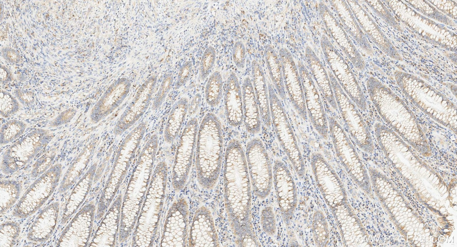 IHC staining of human colorectal cancer using 10627-1-AP Immunohistochemistry (IHC) staining of human colorectal cancer tissue using FADS1 Polyclonal antibody (10627-1-AP)