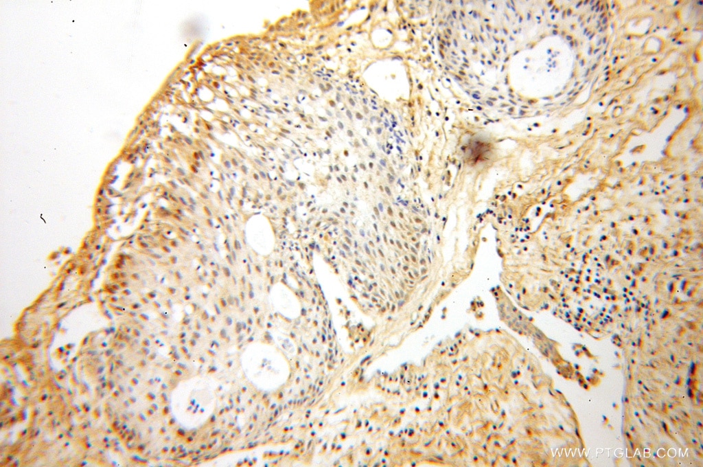 Immunohistochemistry (IHC) staining of human prostate cancer tissue using FAF1 Polyclonal antibody (10271-1-AP)