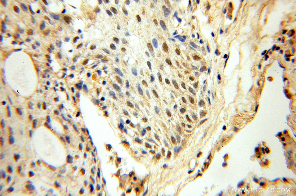 Immunohistochemistry (IHC) staining of human prostate cancer tissue using FAF1 Polyclonal antibody (10271-1-AP)