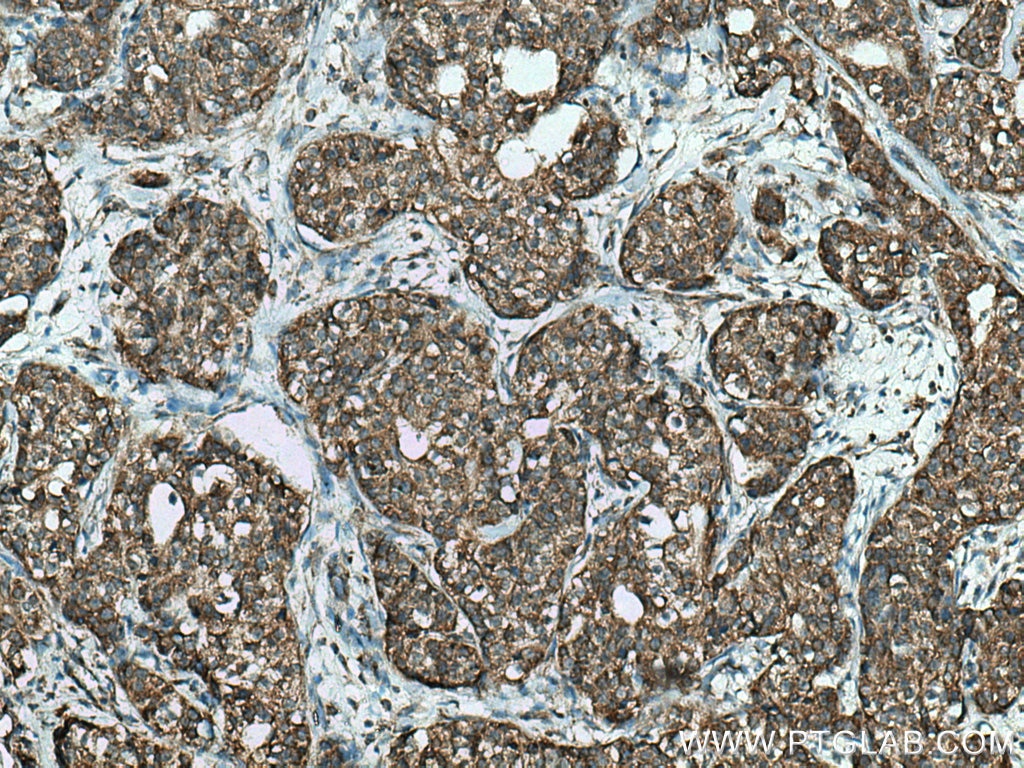 Immunohistochemistry (IHC) staining of human breast cancer tissue using FAF2 Polyclonal antibody (16251-1-AP)