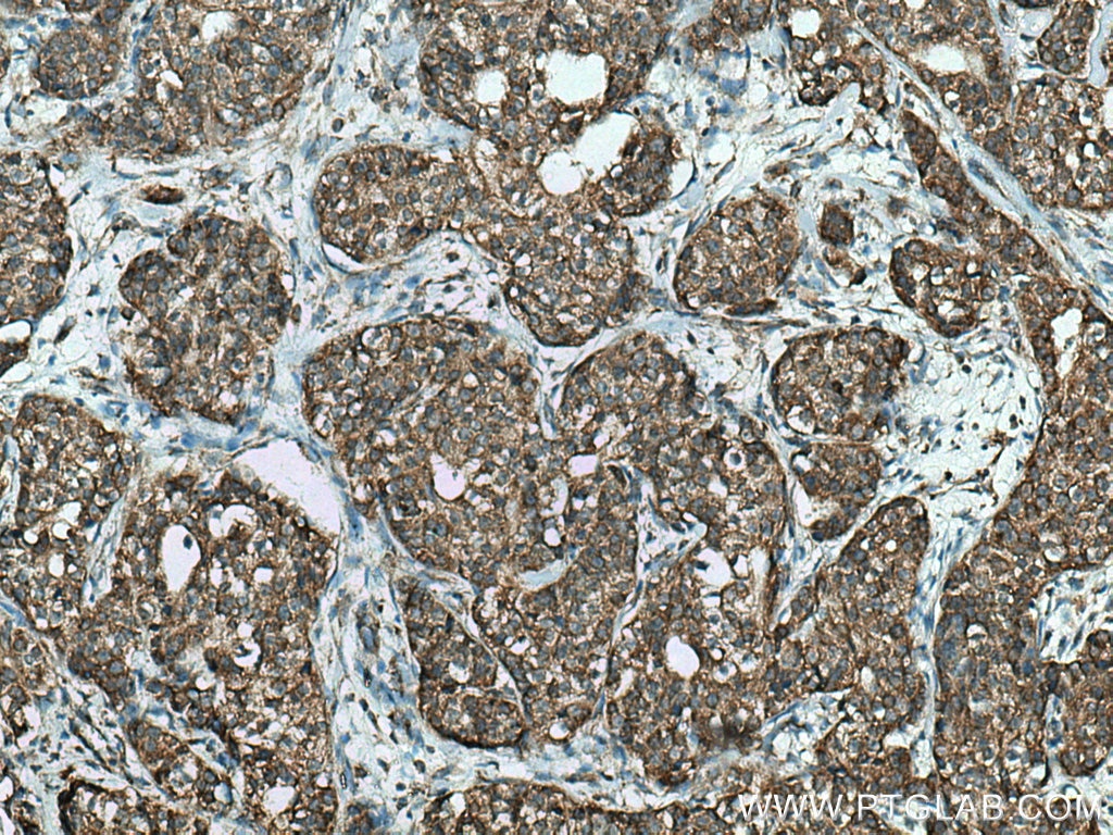 IHC staining of human breast cancer using 16251-1-AP