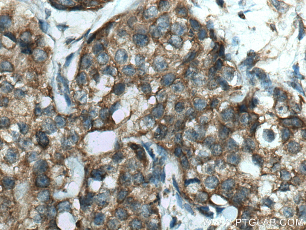 Immunohistochemistry (IHC) staining of human breast cancer tissue using FAF2 Polyclonal antibody (16251-1-AP)