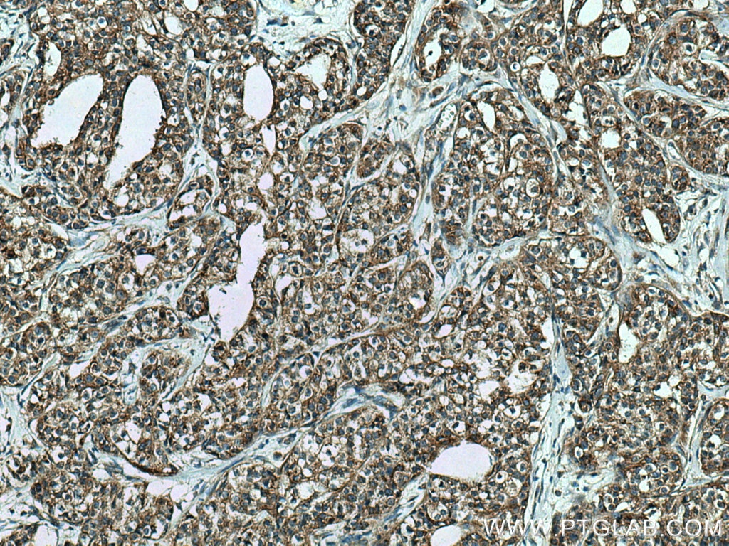 IHC staining of human breast cancer using 66629-1-Ig