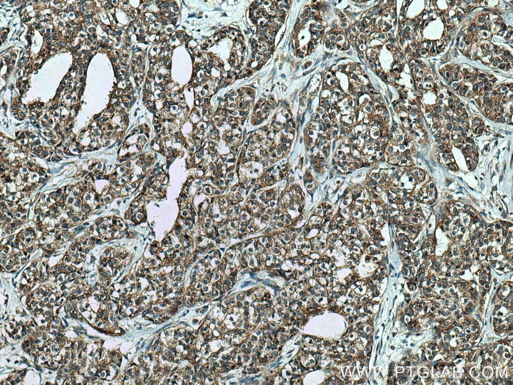 Immunohistochemistry (IHC) staining of human breast cancer tissue using FAF2 Monoclonal antibody (66629-1-Ig)