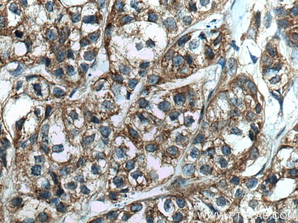 Immunohistochemistry (IHC) staining of human breast cancer tissue using FAF2 Monoclonal antibody (66629-1-Ig)