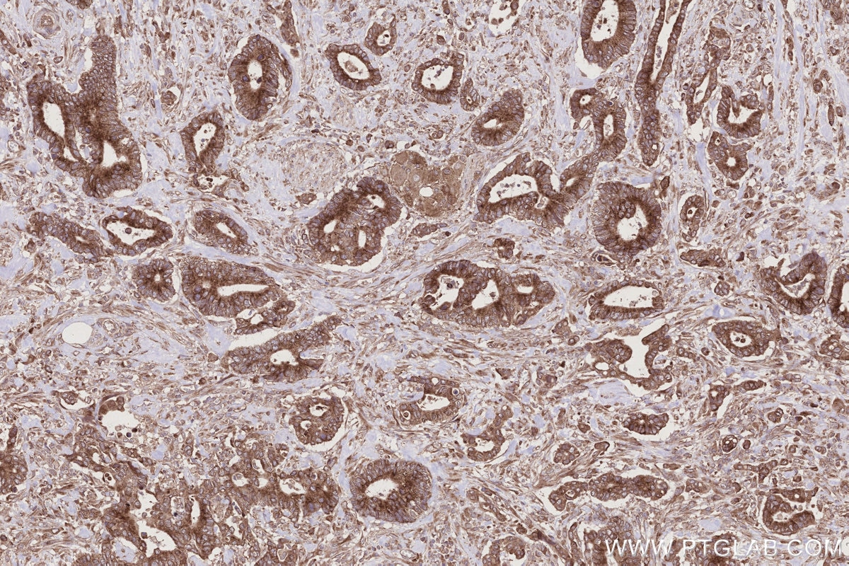 IHC staining of human rectal cancer using 66629-1-Ig Immunohistochemistry (IHC) staining of human rectal cancer tissue using FAF2 Monoclonal antibody (66629-1-Ig)