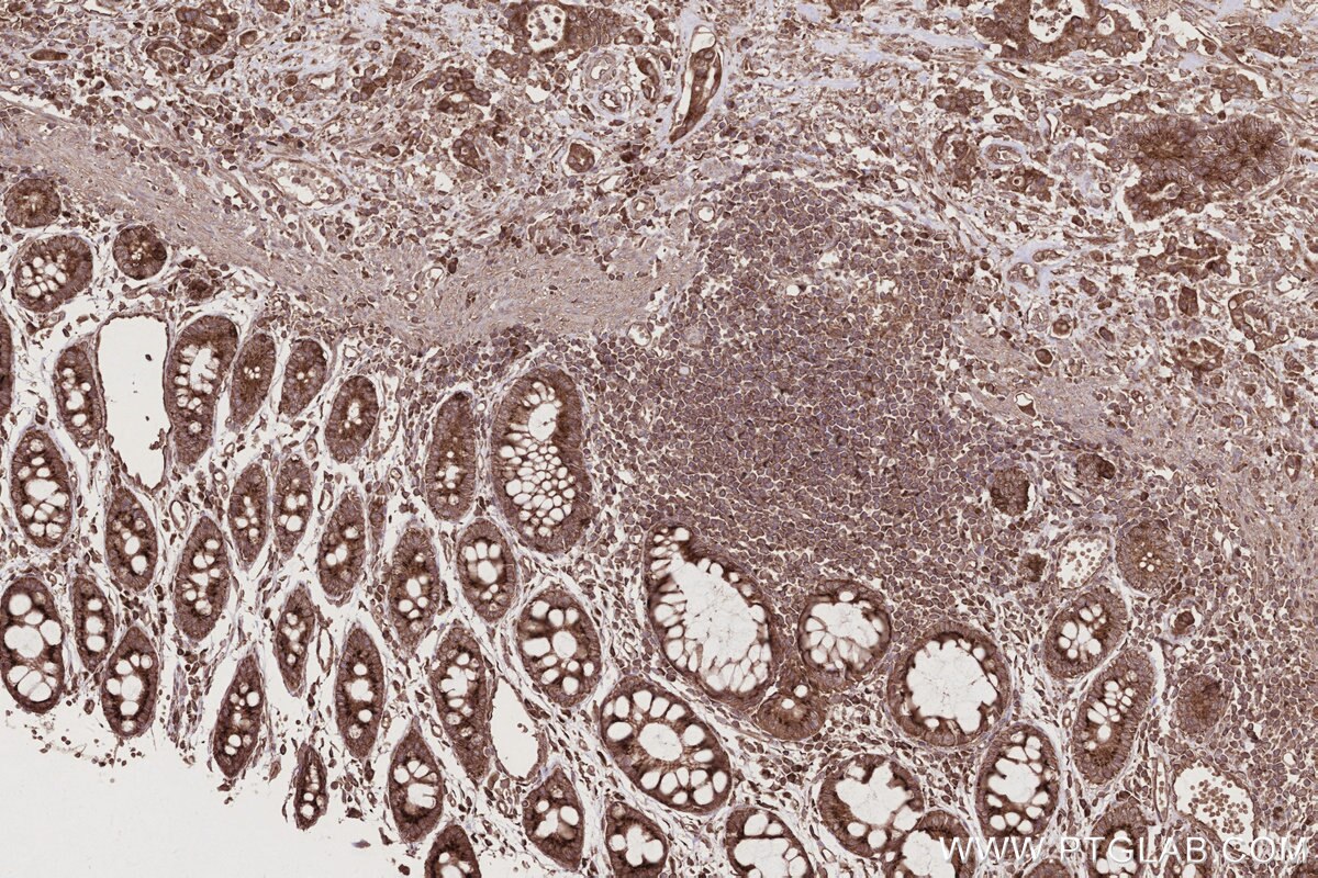 IHC staining of human rectal cancer using 66629-1-Ig Immunohistochemistry (IHC) staining of human rectal cancer tissue using FAF2 Monoclonal antibody (66629-1-Ig)