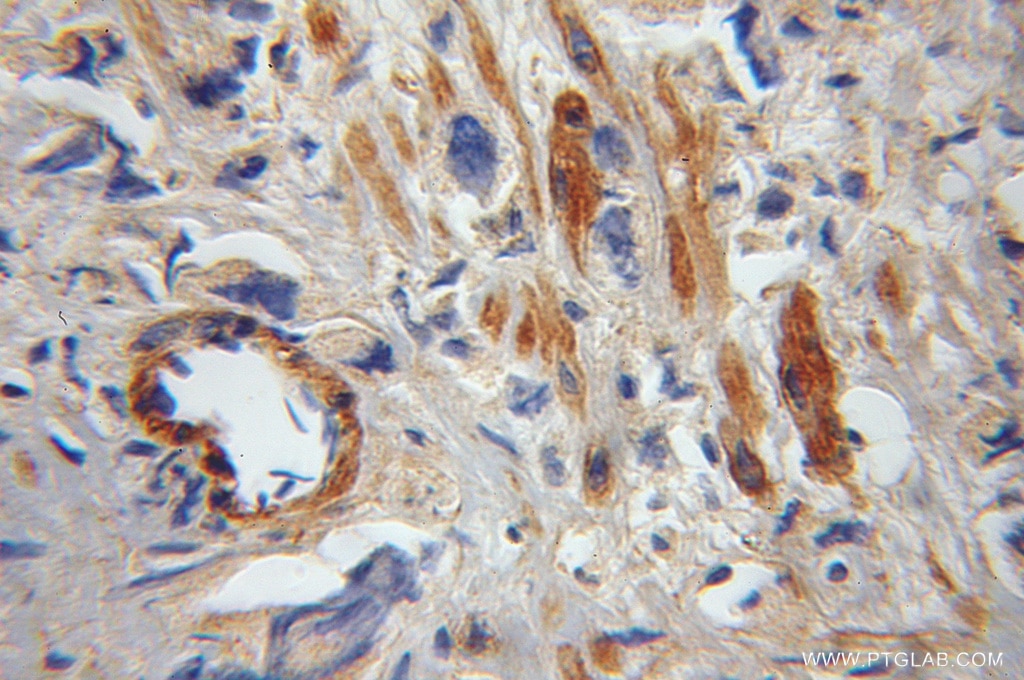 Immunohistochemistry (IHC) staining of human gliomas tissue using FAIM Polyclonal antibody (13005-1-AP)
