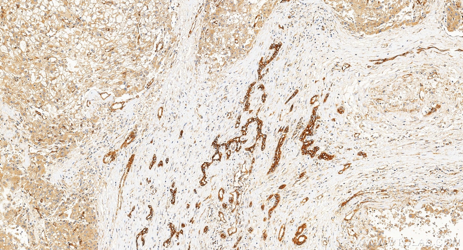 IHC staining of Hepatocellular carcinoma using 12636-1-AP Immunohistochemistry (IHC) staining of Hepatocellular carcinoma tissue using FAK Polyclonal antibody (12636-1-AP)