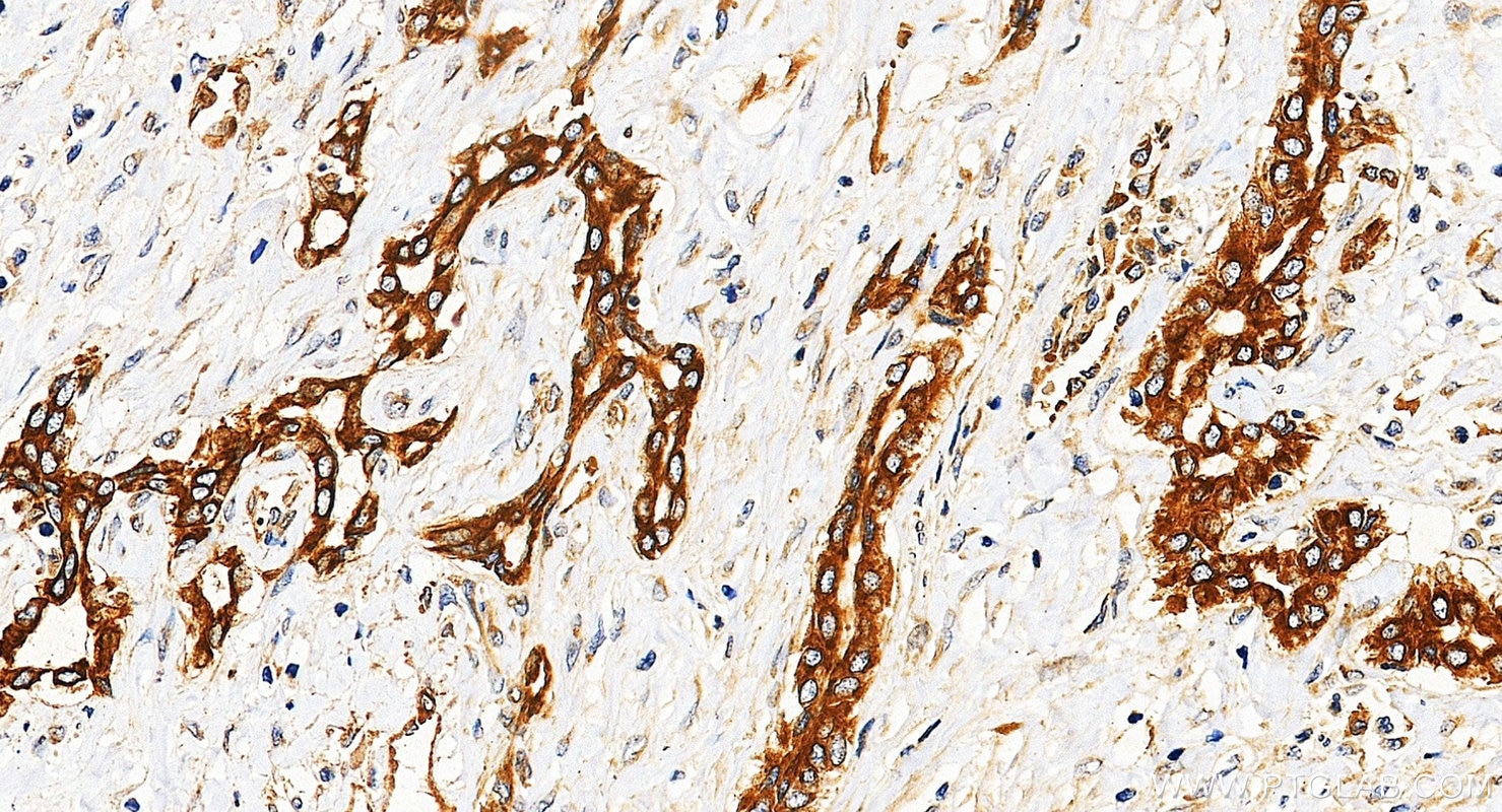 IHC staining of Hepatocellular carcinoma using 12636-1-AP Immunohistochemistry (IHC) staining of Hepatocellular carcinoma tissue using FAK Polyclonal antibody (12636-1-AP)
