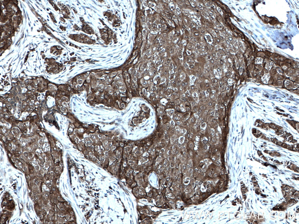 IHC staining of human breast cancer using 12636-1-AP