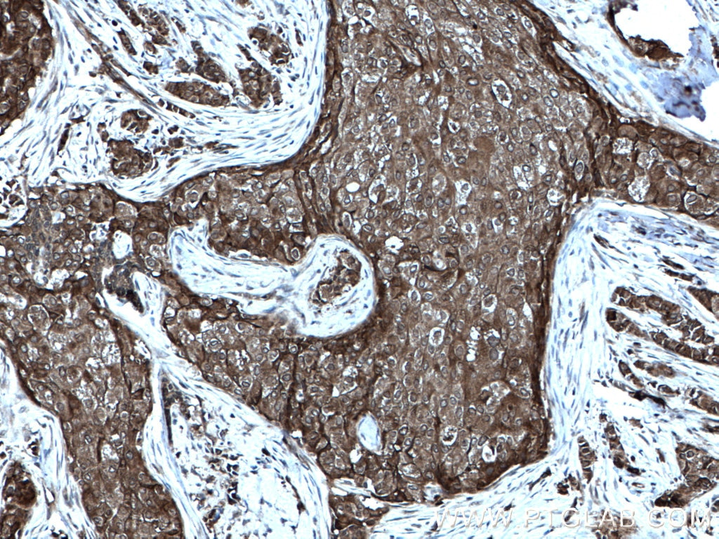 Immunohistochemistry (IHC) staining of human breast cancer tissue using FAK Polyclonal antibody (12636-1-AP)