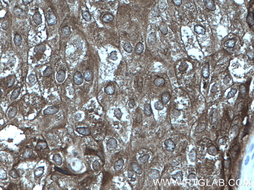 IHC staining of human breast cancer using 12636-1-AP