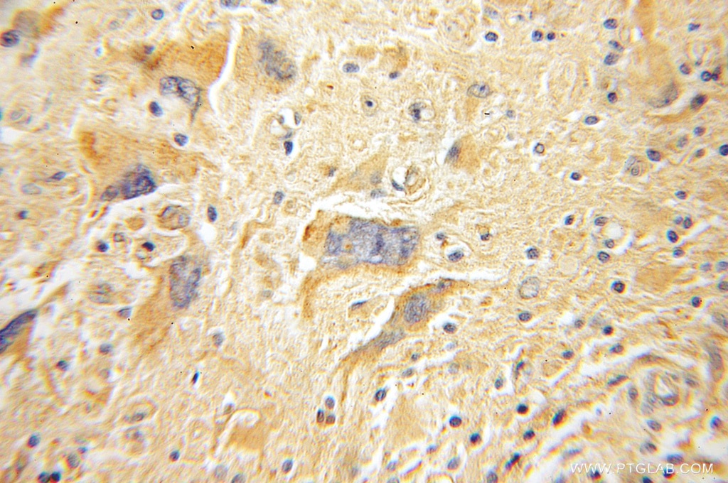 Immunohistochemistry (IHC) staining of human gliomas tissue using FAK Polyclonal antibody (12636-1-AP)