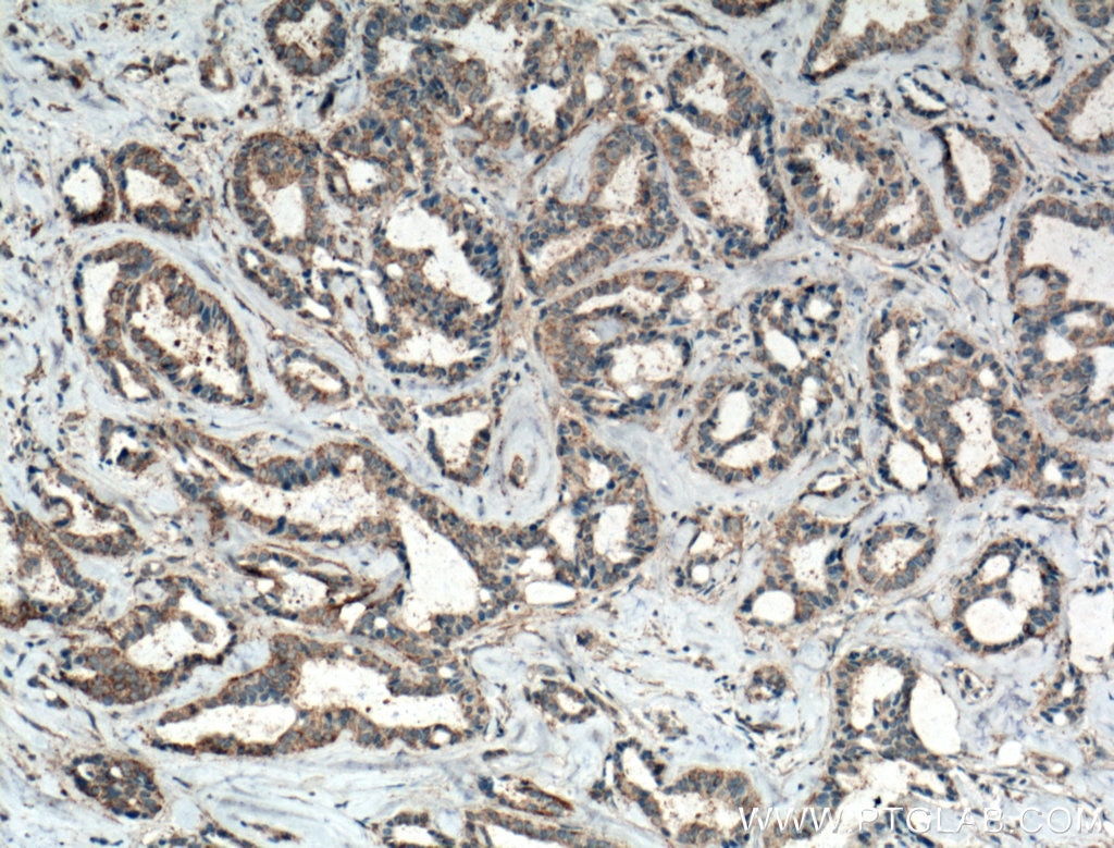 Immunohistochemistry (IHC) staining of human breast cancer tissue using FAK Monoclonal antibody (66258-1-Ig)