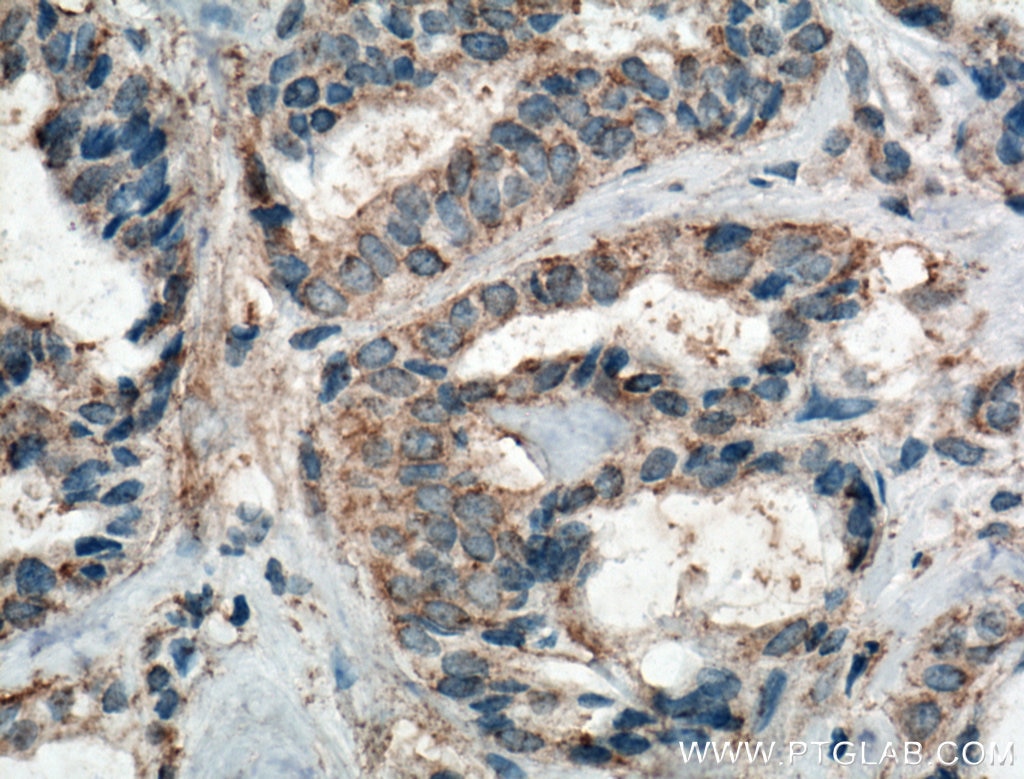 Immunohistochemistry (IHC) staining of human breast cancer tissue using FAK Monoclonal antibody (66258-1-Ig)